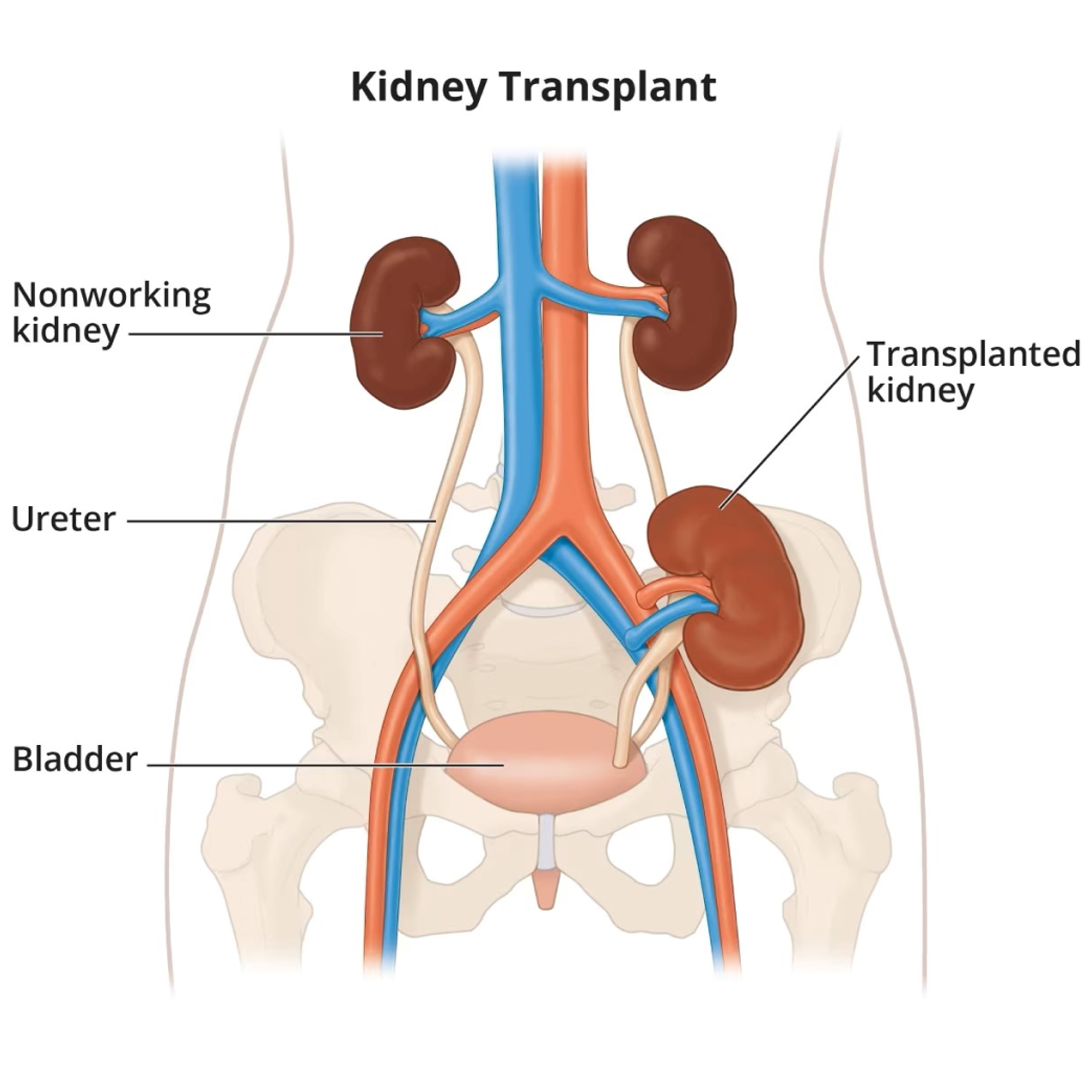 Kidney Transplantation – things I should know !!