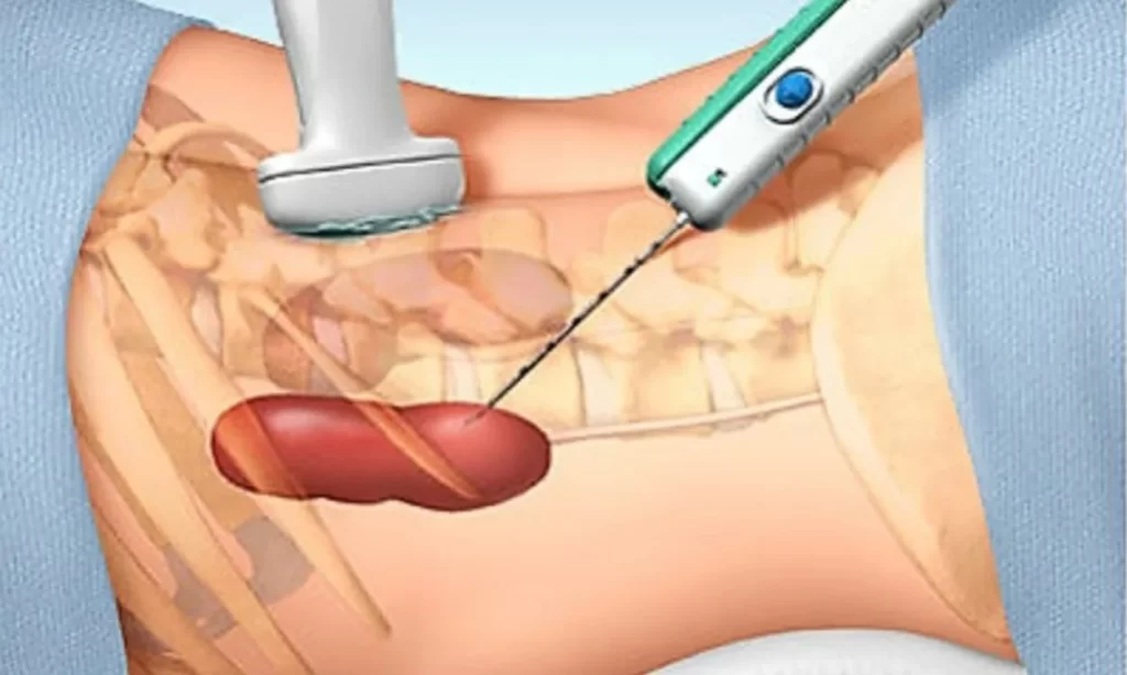 Kidney Biopsy Indicaton