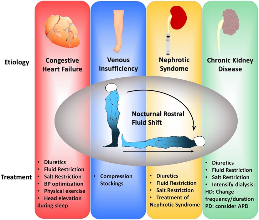 Know About Edema and Obstructive Sleep Apnea Sept 2024