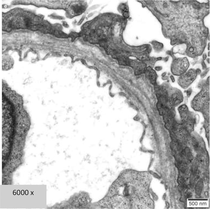 Why Electron Microscopy Crucial in Renal Biopsy.