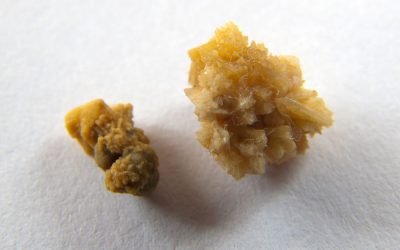 Kidney stones treatment consultation with Dr. Suhas Mondhe